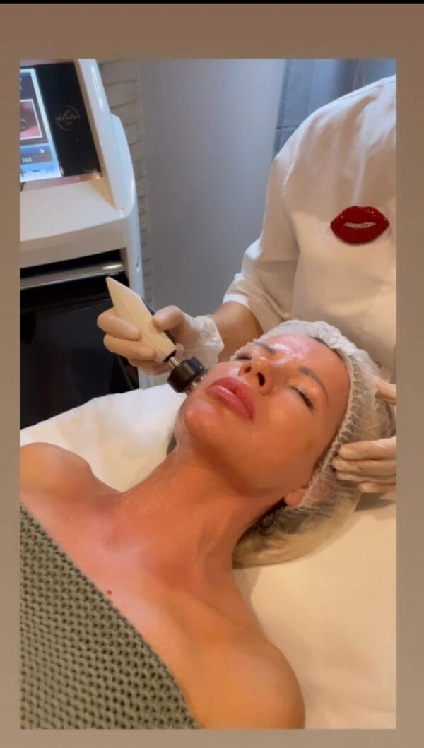 RF face lifting (Radiofrequency) - Image 2